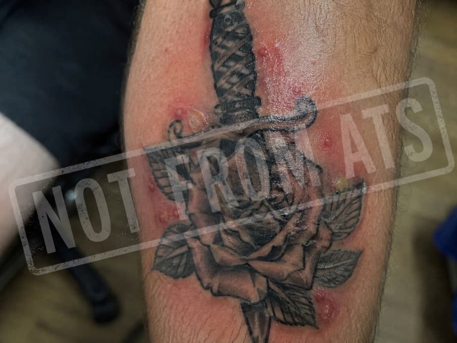 An infected, poorly-healing tattoo showing redness and raised bumps — a sign to seek care (not an American Tattoo Society tattoo)